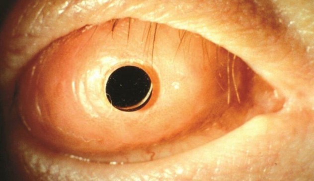 OOKP oeil vue